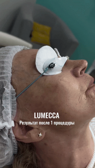 Как убрать пигмент на лице за одну процедуру 